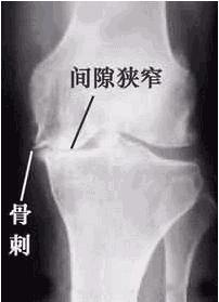 引起骨质增生的原因有哪些?