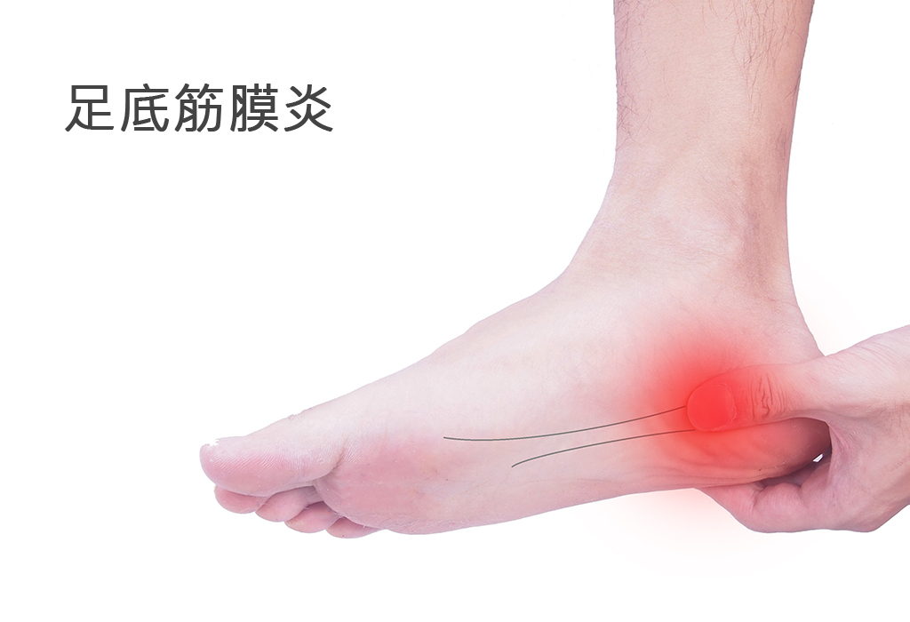 什么是筋膜炎呢